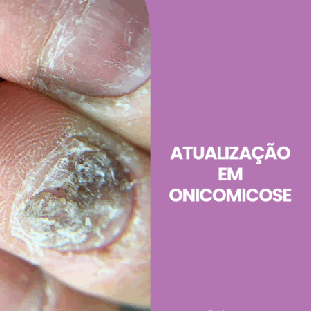 ONICOMICOSE